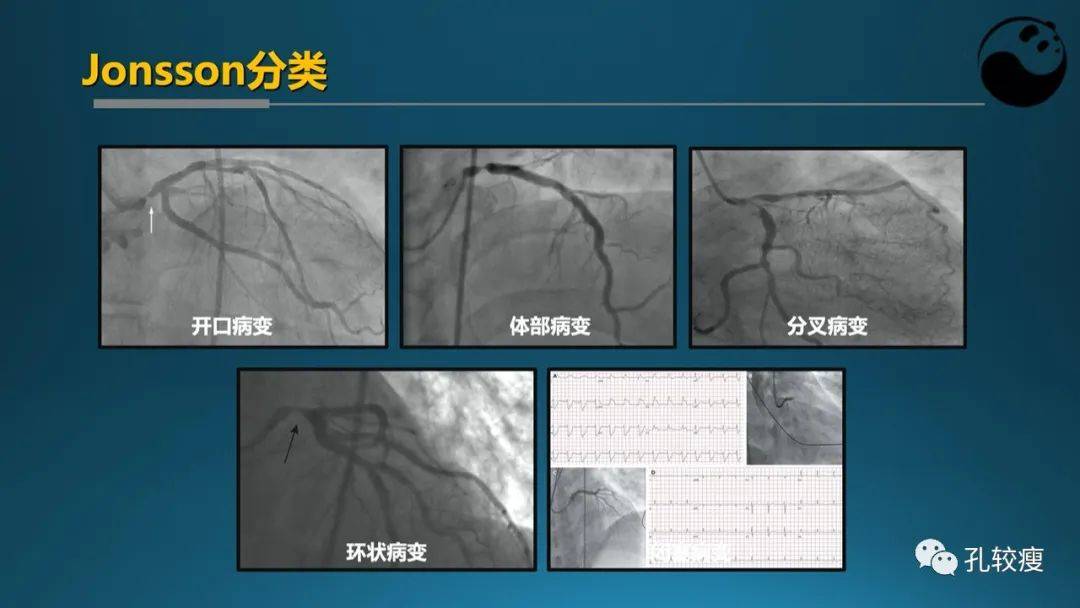 心脏造影图解析图片