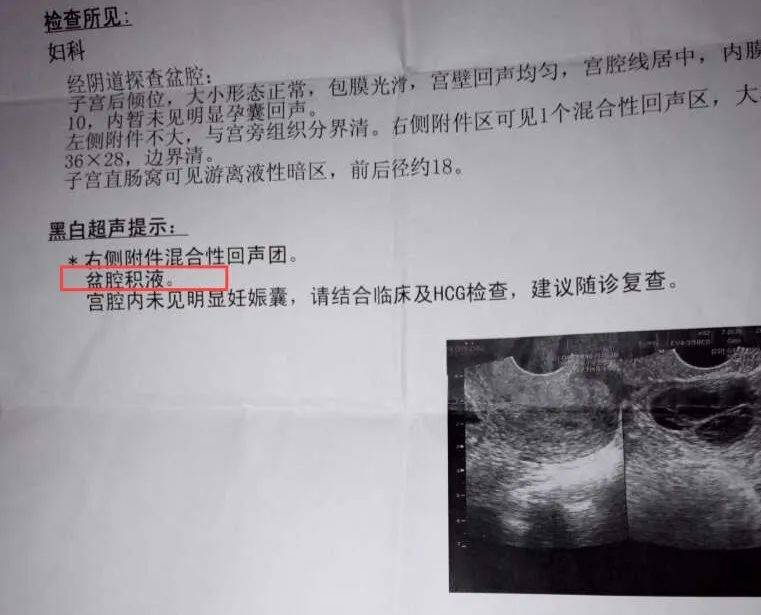 盆腔炎症,宫外孕,卵巢囊肿破裂等情况可能出现病理性的盆