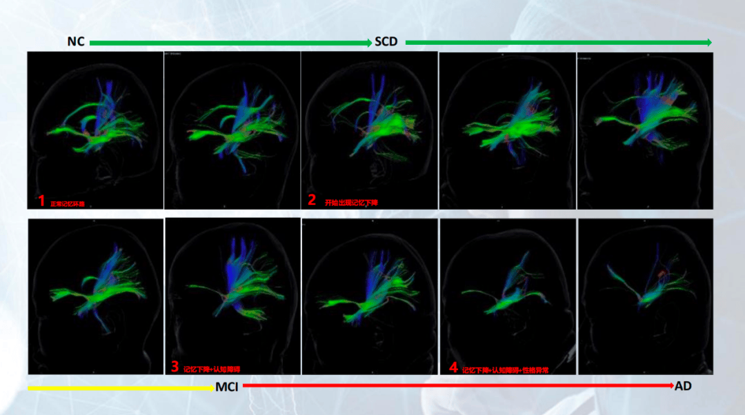 博医来特约 | 任廷文博士:如何应用脑图谱ai软件 通