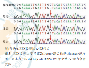 【病例报告】pex13基因变异致儿童zellweger综合征1例