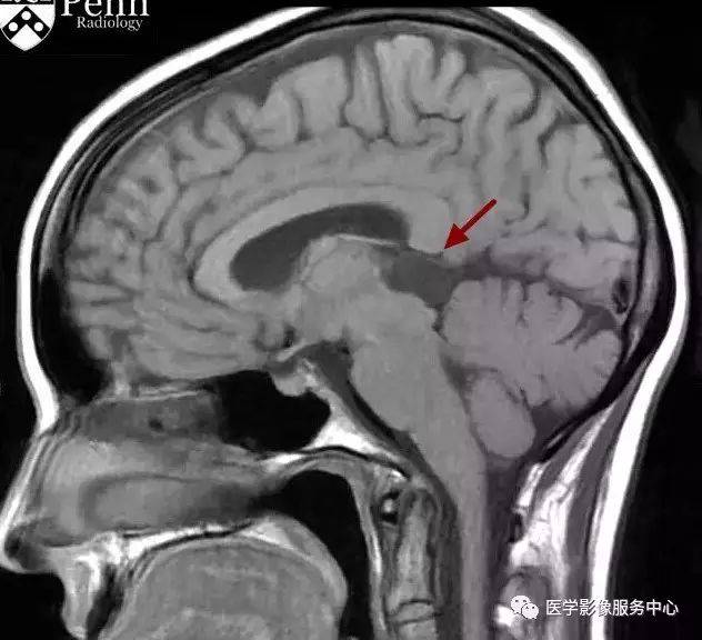 典型松果体区病变,过目不忘