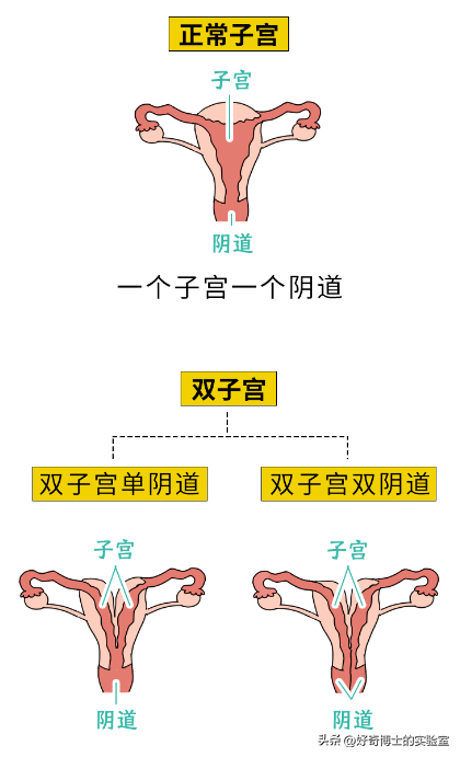 畸形双子宫双宫颈图片图片