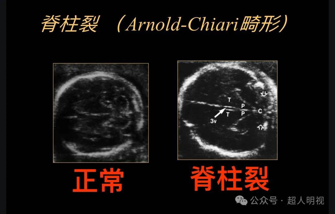 大脑外侧裂超声图图片