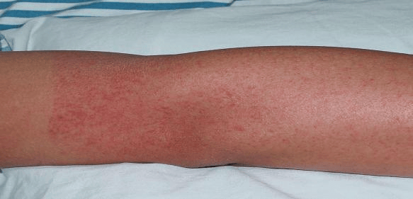 【伟才保健】"蚊子肆虐,登革热防控攻略来袭!