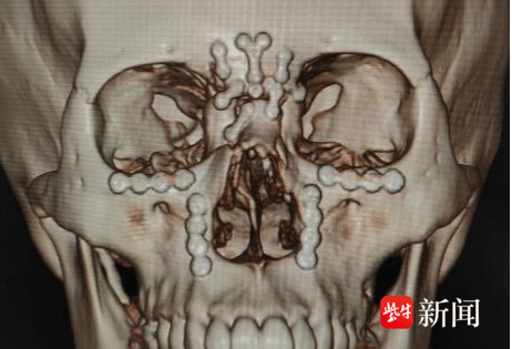 术前头颅ct三维重建专家介绍,鼻眶筛骨折是指发生于眼眶间的骨折,处于