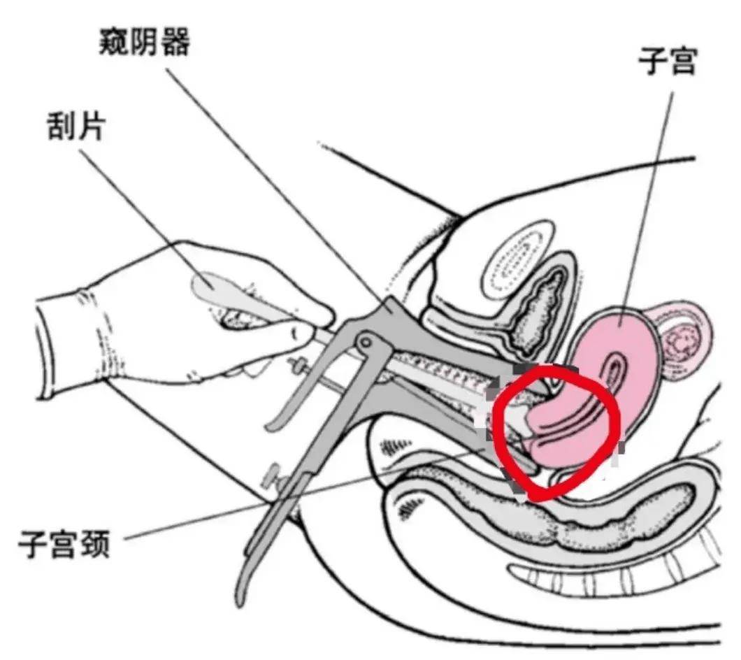 妇科检查鸭嘴怎么使用图片