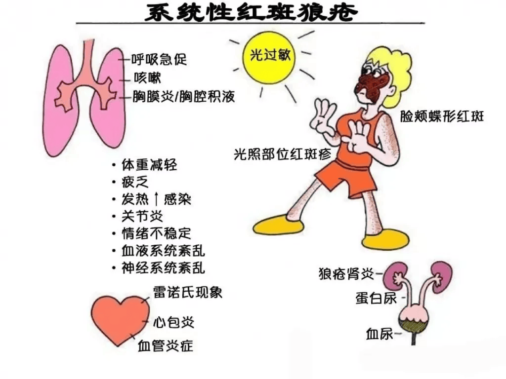 三,引起红斑狼疮发病的因素有哪些?