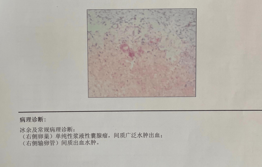 术后常规病理示:(右侧卵巢)单纯性浆液性囊腺瘤,间质广泛水肿出血