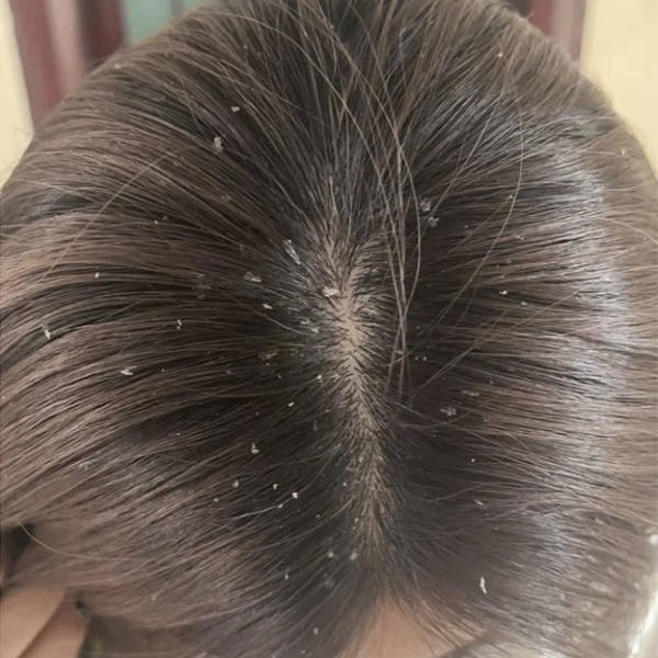 去屑止痒控油不错的洗发水排行榜_头皮屑_头发_问题