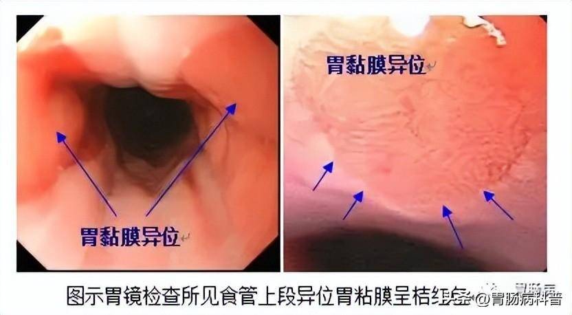 巴雷特食管全周型图片