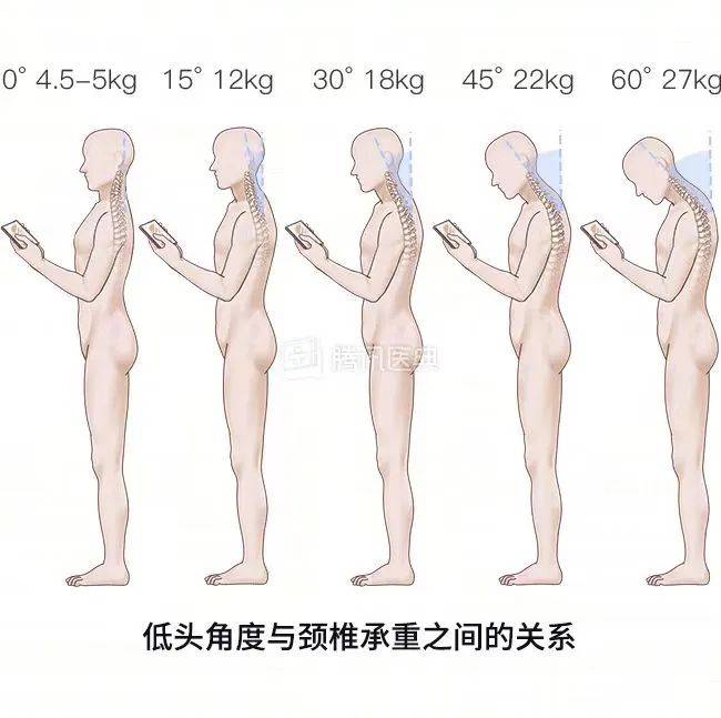 女生背部脊柱突出图片图片