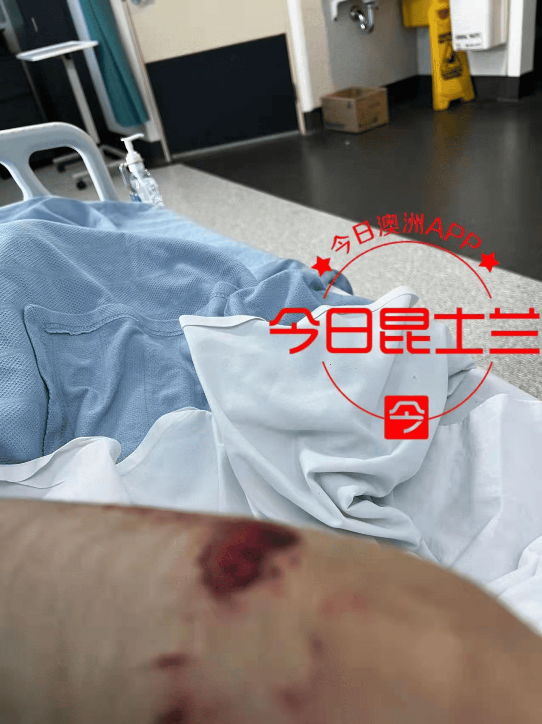 uq中国女留学生惨遭车祸,当街被撞昏迷,全身多处骨折,脑震荡!