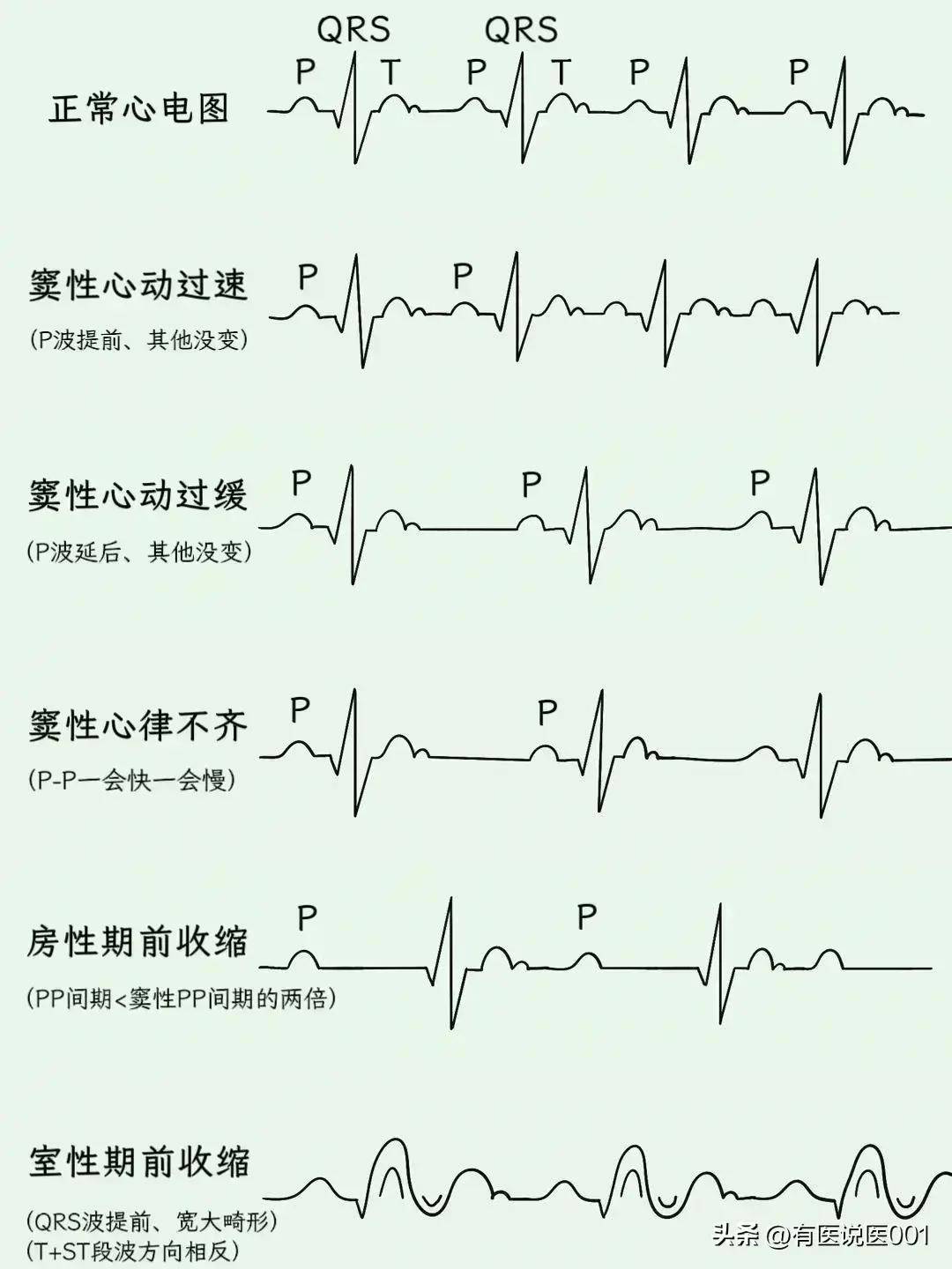 心电图的正常值范围图片