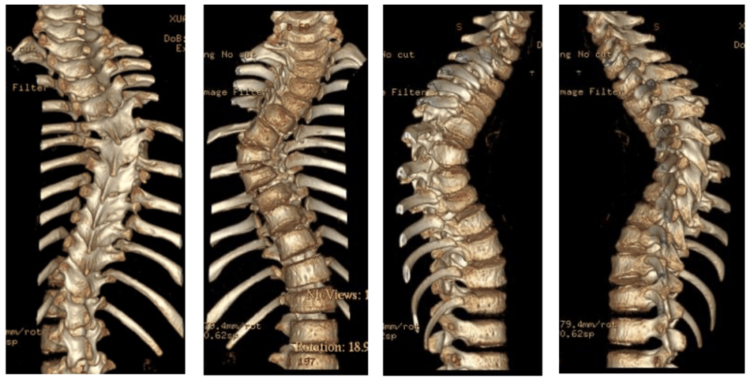 宣武有术|脊柱侧弯生长棒矫形