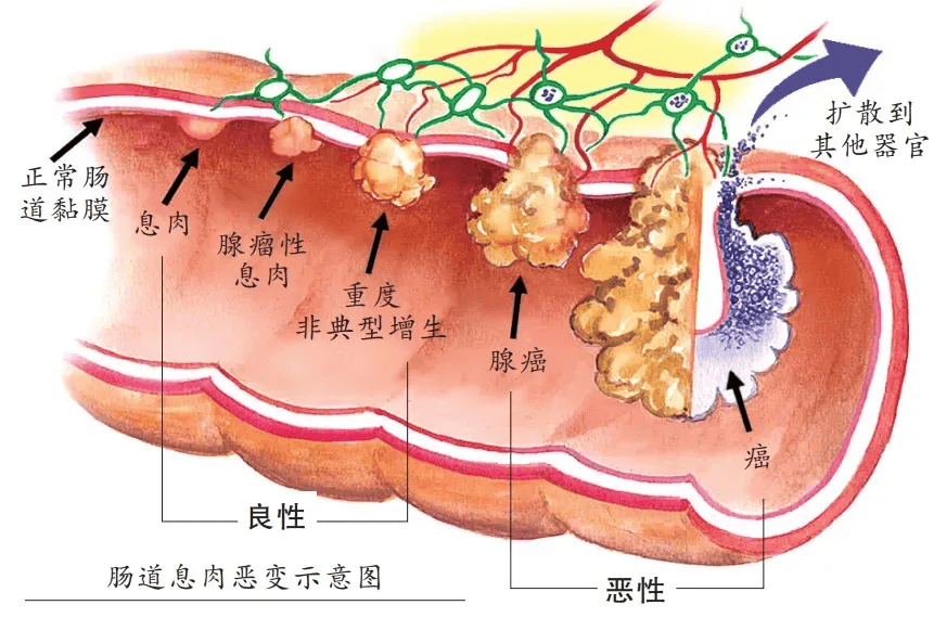 回肠息肉图片