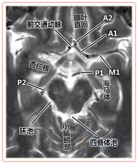 willis环与大脑供血图片