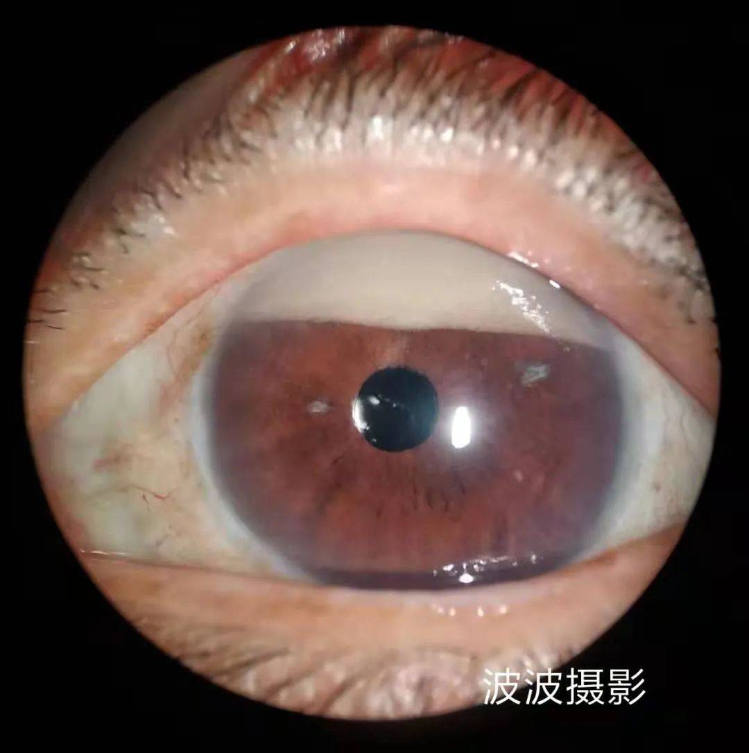 眼科图谱100张 | 裂隙灯下眼科图片分享_角膜_秘籍_医生