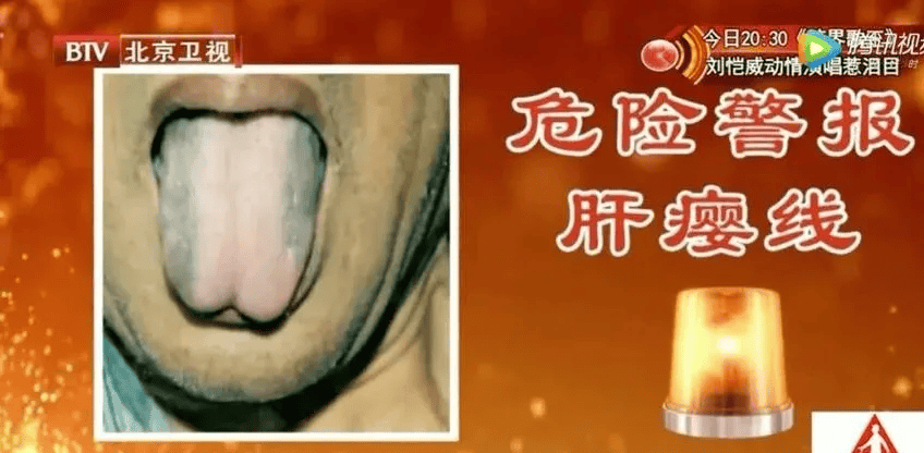 其后,王氏榕平专门做了"原发性肝癌的肝瘿线与血液流变学关系初探"一