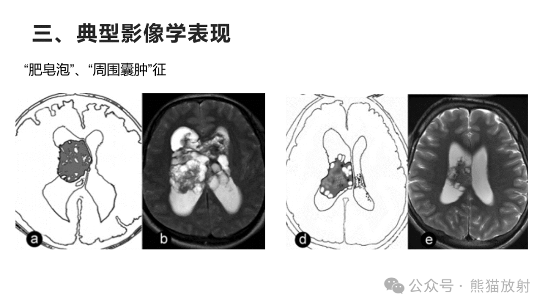 侧脑室肿瘤图片