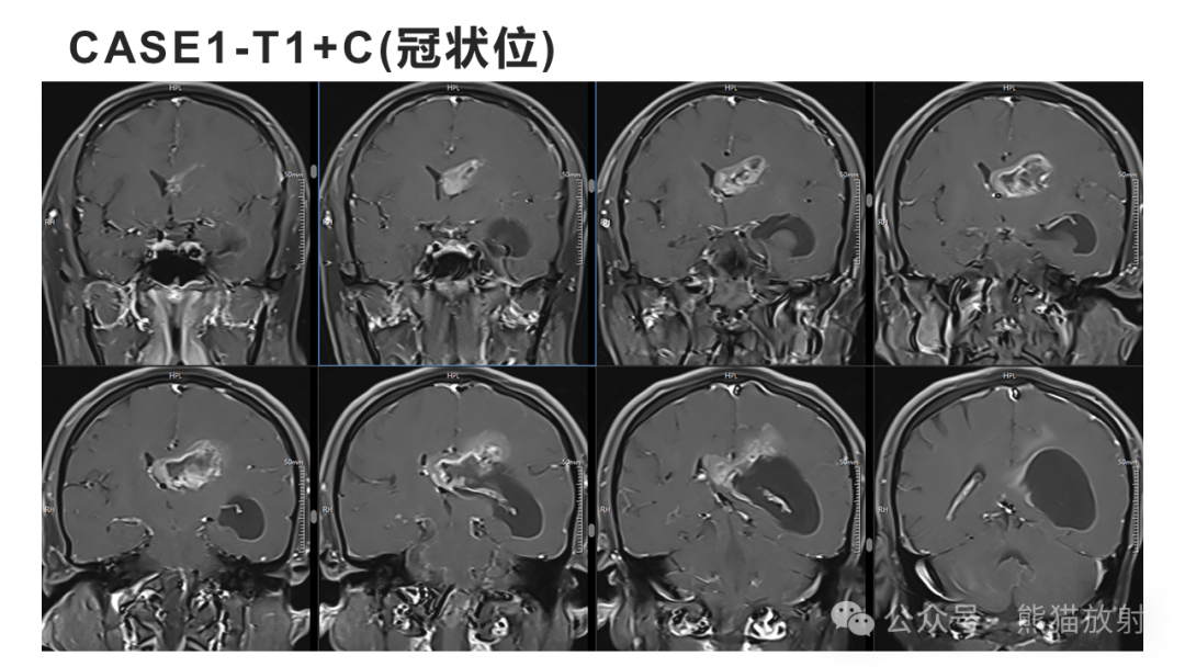 侧脑室肿瘤图片