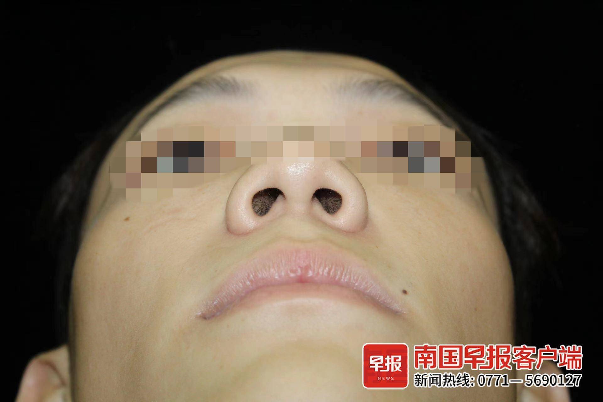 今年1月,他到格林美菲江南万达广场店花费6780元做鼻子整形手术,以