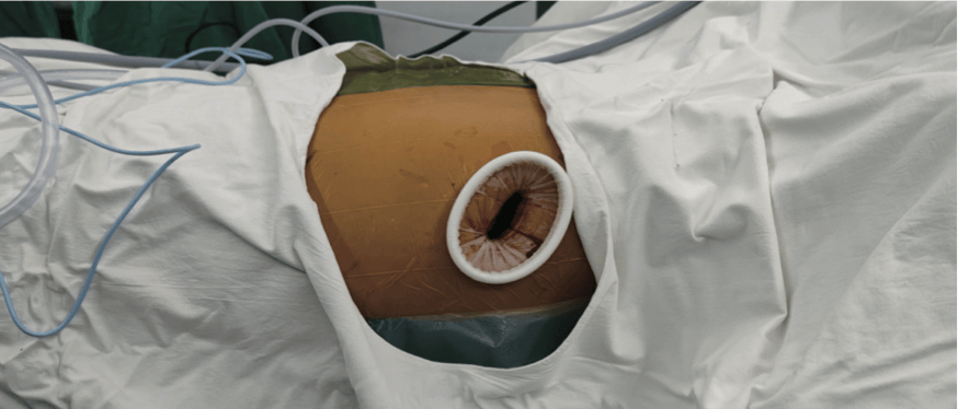 单孔胸腔镜食管癌根治术(胸腔部分)|《胸外科单孔腔