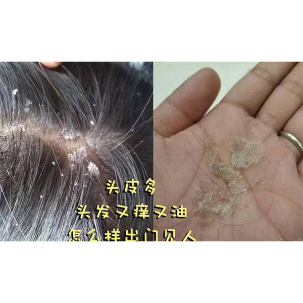 容易长头皮屑的用什么洗发水?控油去屑效果好的洗发水介绍