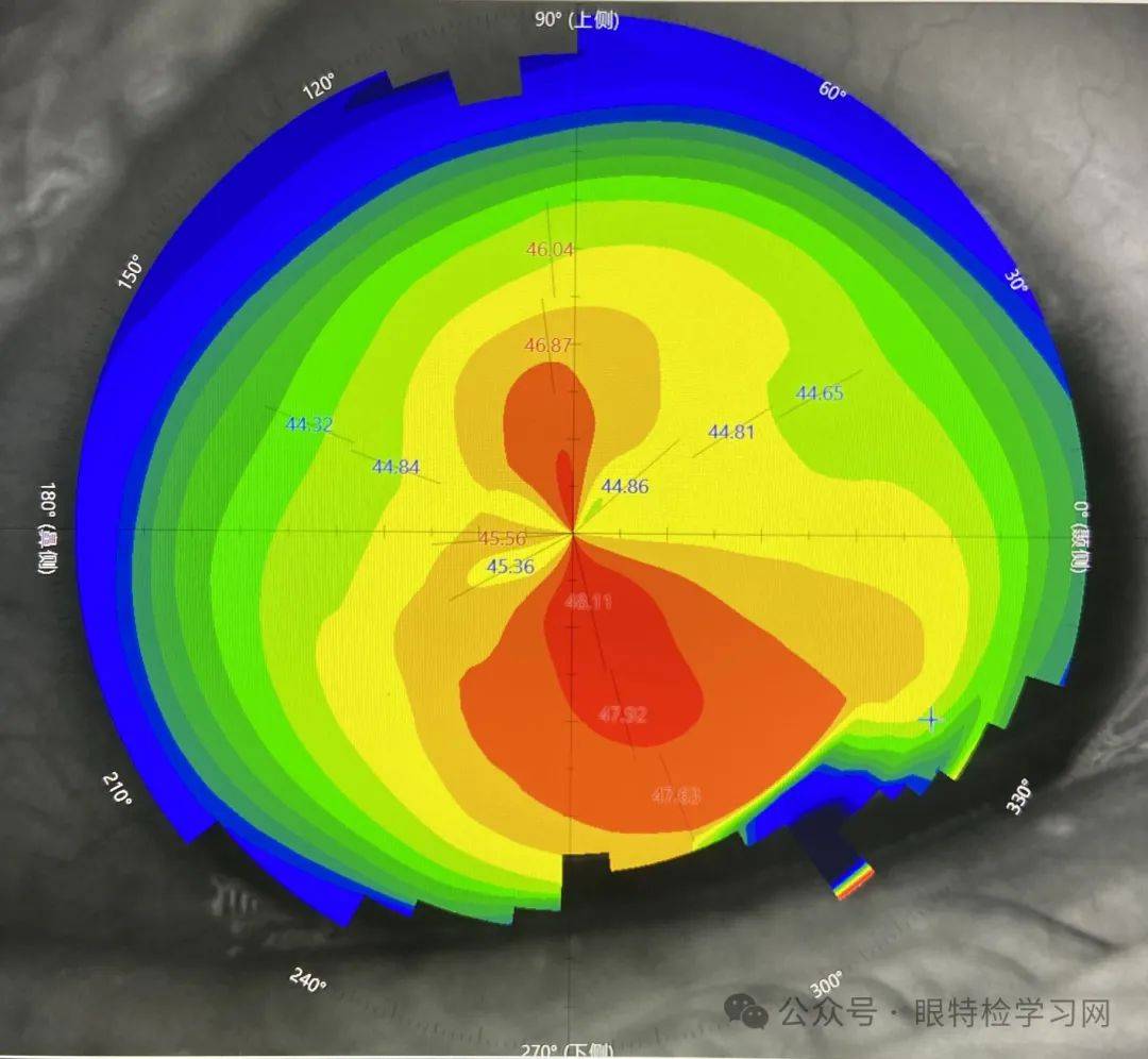 角膜地形图高度图分析图片