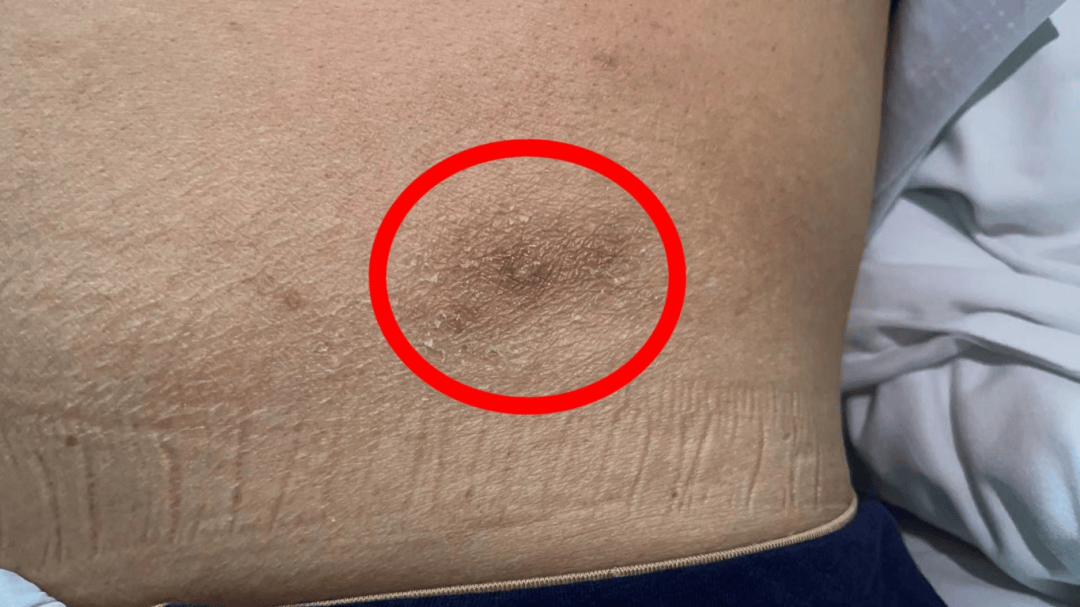 宁波一对母女双双确诊癌症!医生提醒:出现这种情况,直系三代要注意