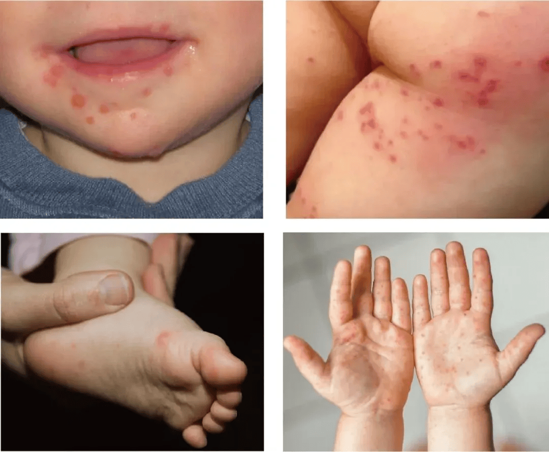 临床表现多以发热,手,足,口,臀部位出现斑丘疹,疱疹为主要特征