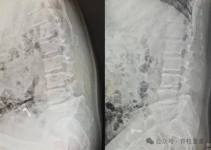 腰椎多了一节患者跨越3400公里找他手术