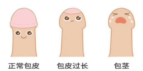 来了,温医大附一院暑期包皮手术开始预约啦!