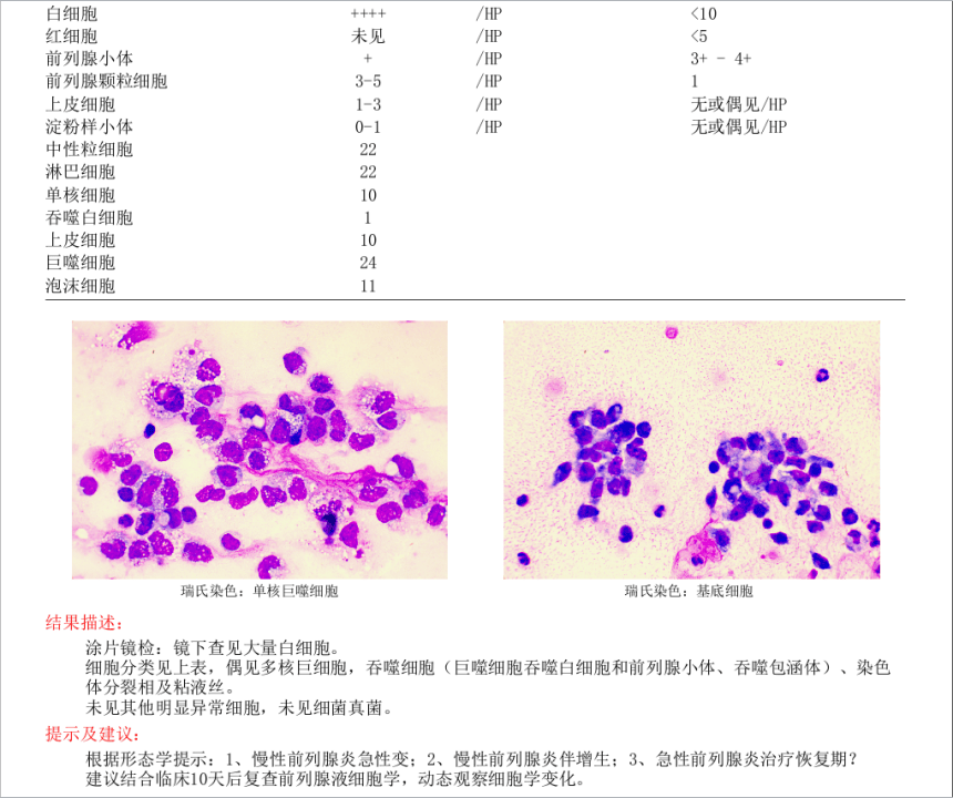 前列腺液白细胞图片