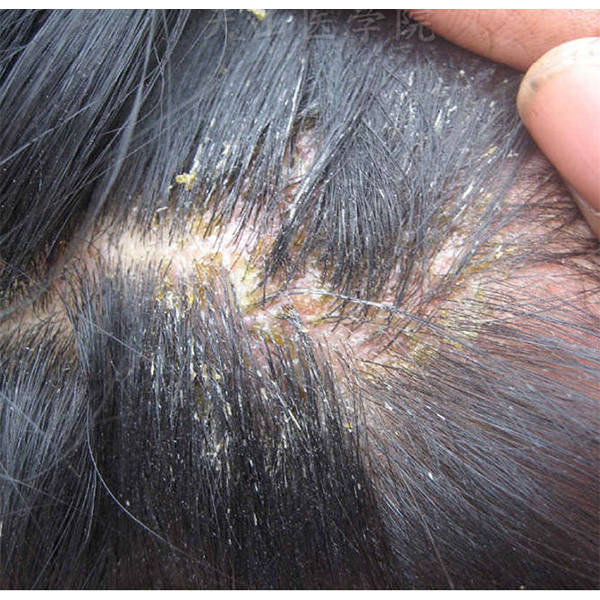 下:头皮屑和小红疹的产生原因包括:脂溢性皮炎:过多的皮脂分泌可能