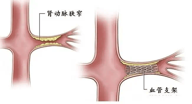 肾动脉在哪个位置图片图片