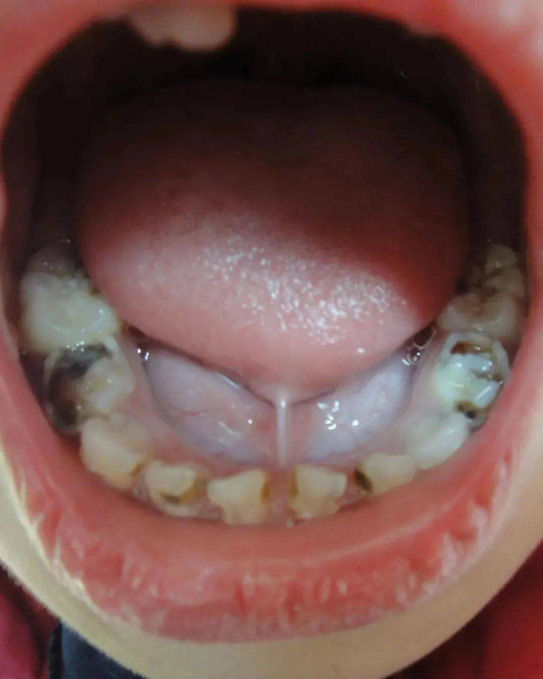 儿童龋齿龋病,作为一种由细菌引发的疾病,主要对牙体硬组织造成破坏