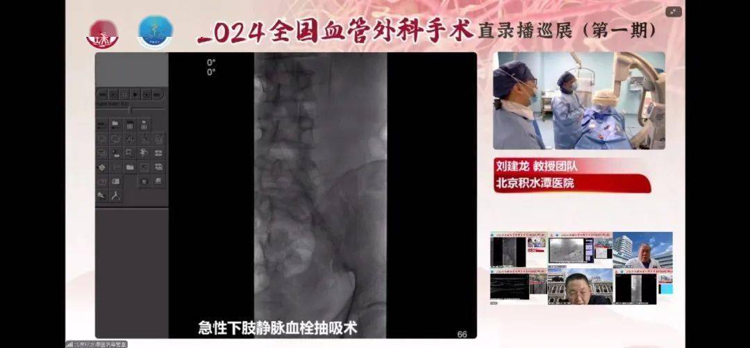 学术交流丨我院血管外科参与2024全国血管外科手术直录播巡展