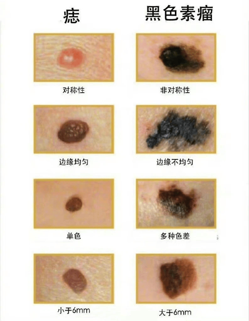 恶性黑色素瘤晚期症状图片