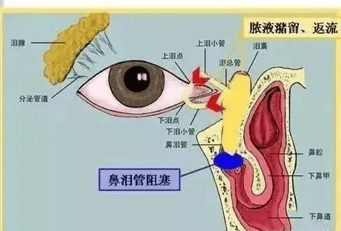 【夏季科普季】慢性泪囊炎如何治疗?_手术_鼻腔_阻塞