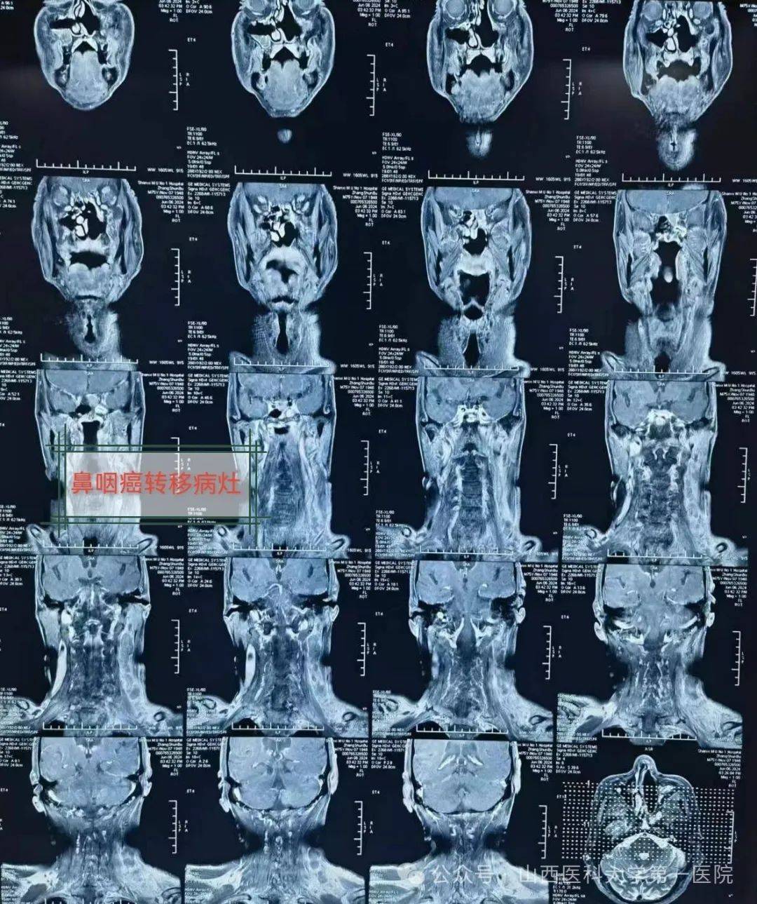 七旬老人鼻咽癌放疗后颈部淋巴结复发转移 山西医科大学第一医院实施