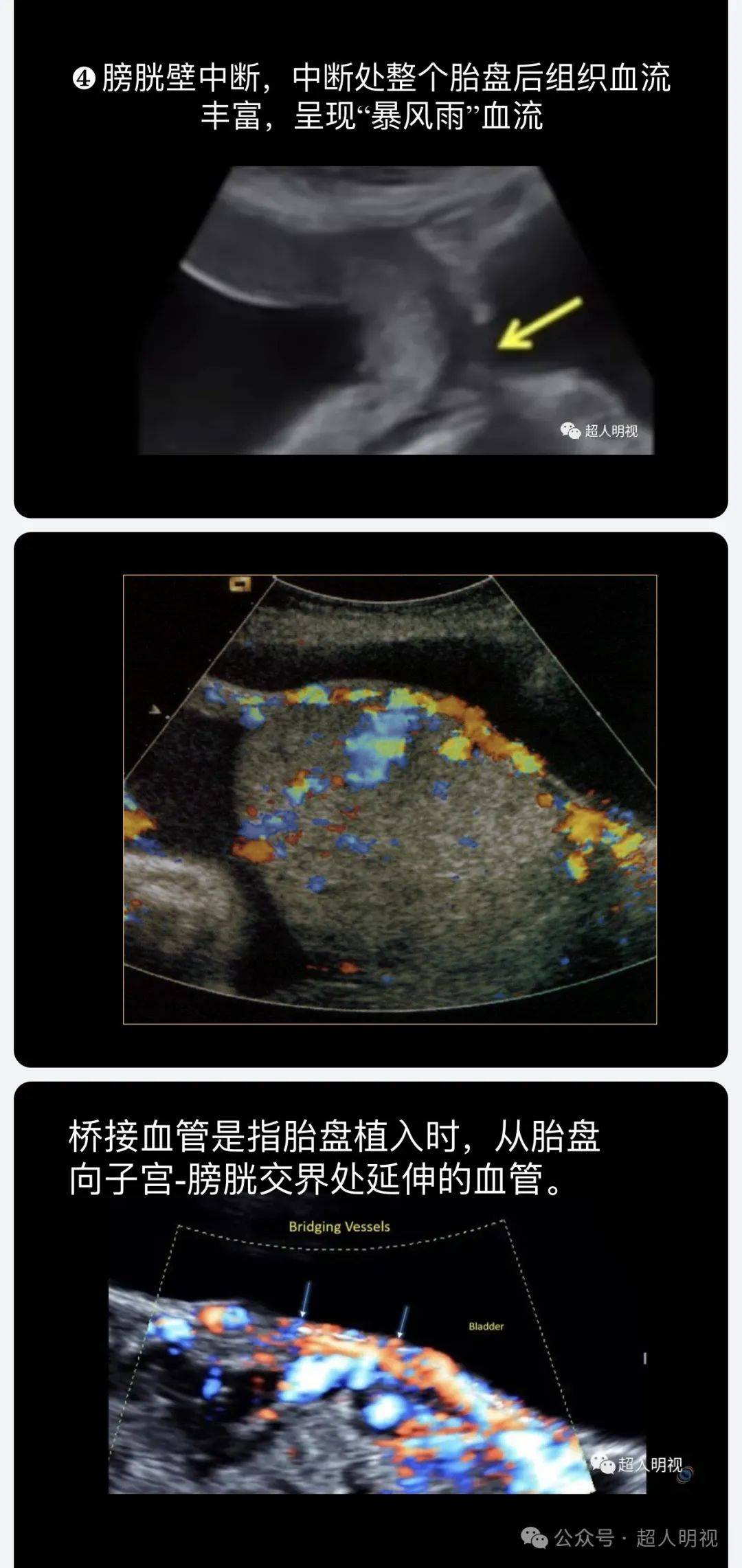 副胎盘超声声像图图片