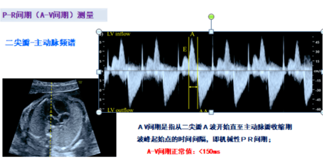 p-r间期测量及临床应用