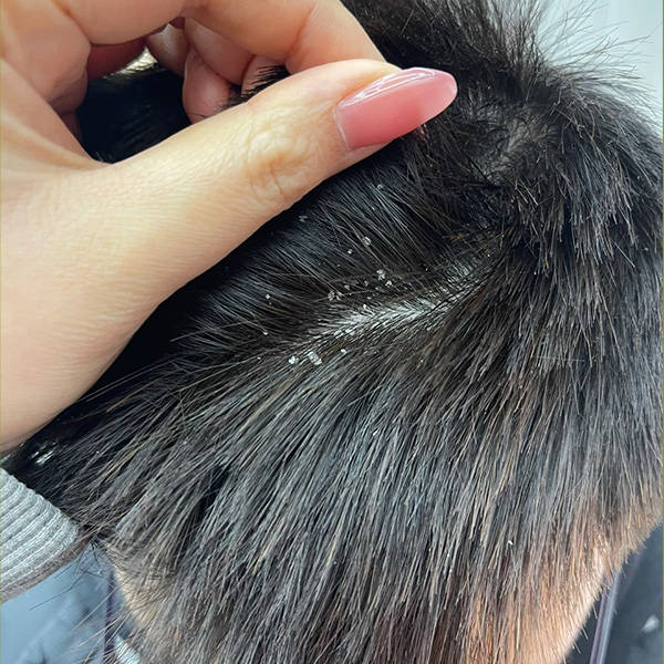  p>去顽固头屑用什么洗发水在生活中,头皮屑可能会给我们带来不同的