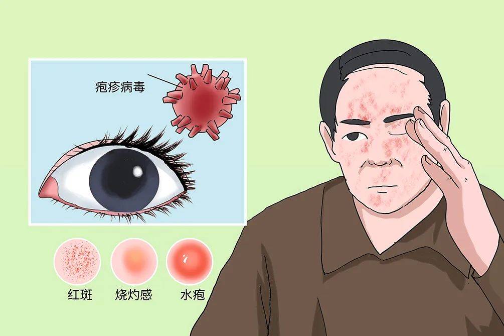 警惕!口唇长这种泡可不是上火哦,小心这种传染性很强的病毒!