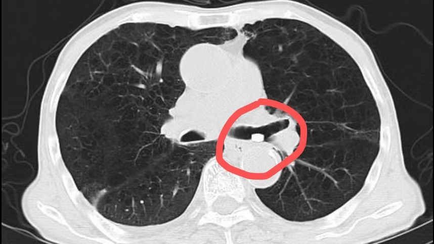 患者刘爷爷因误吸药丸出现呛咳,气促紧急入院,胸部ct显示,左下叶支