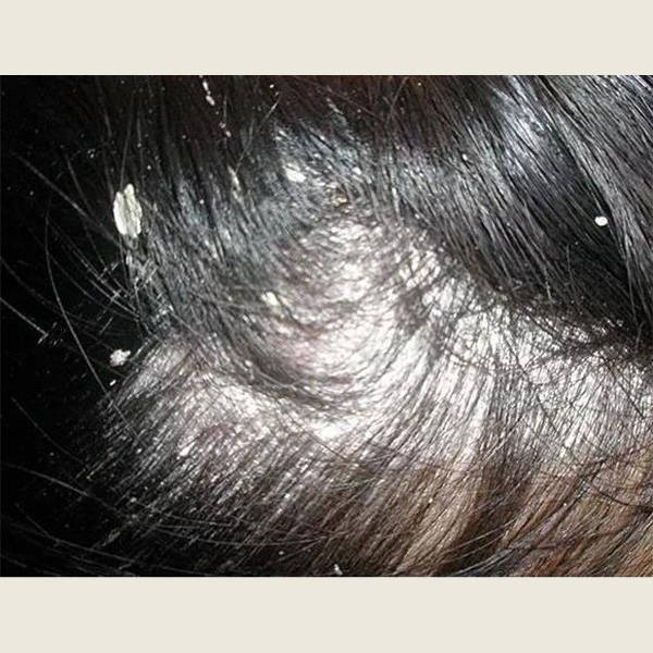 脂溢性皮炎是其中一个主要原因,这是因为头皮上的油脂分泌过多,导致
