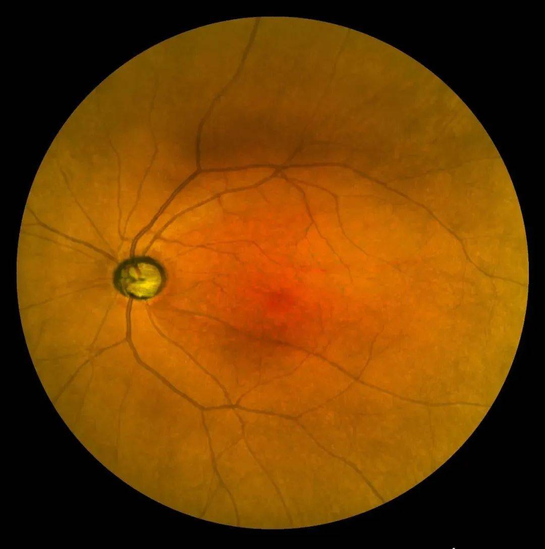 每个人都要拍一张眼底照