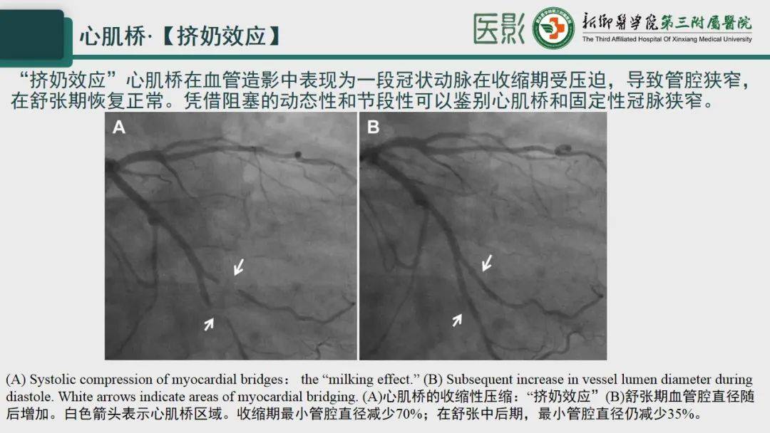 冠脉cta—心肌桥诊断要点