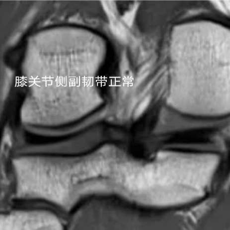 患者在尝试下蹲时,由于韧带的损伤和疼痛,可能会感到关节不稳定,从而