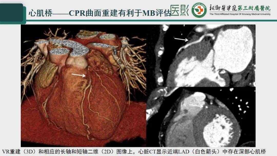 冠脉cta—心肌桥诊断要点